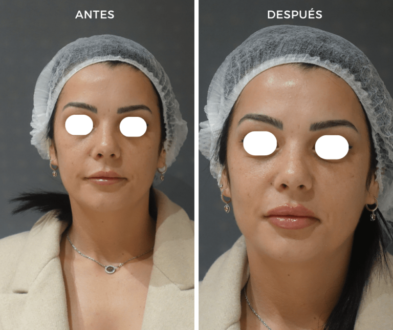Foto A. Relleno de labios con Ácido hialurónico - Elegant Clinic Banús
