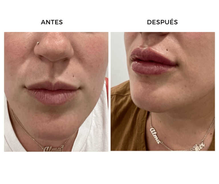 Aumento de labios con Ácido hialurónico - Elegant Clinic Banús