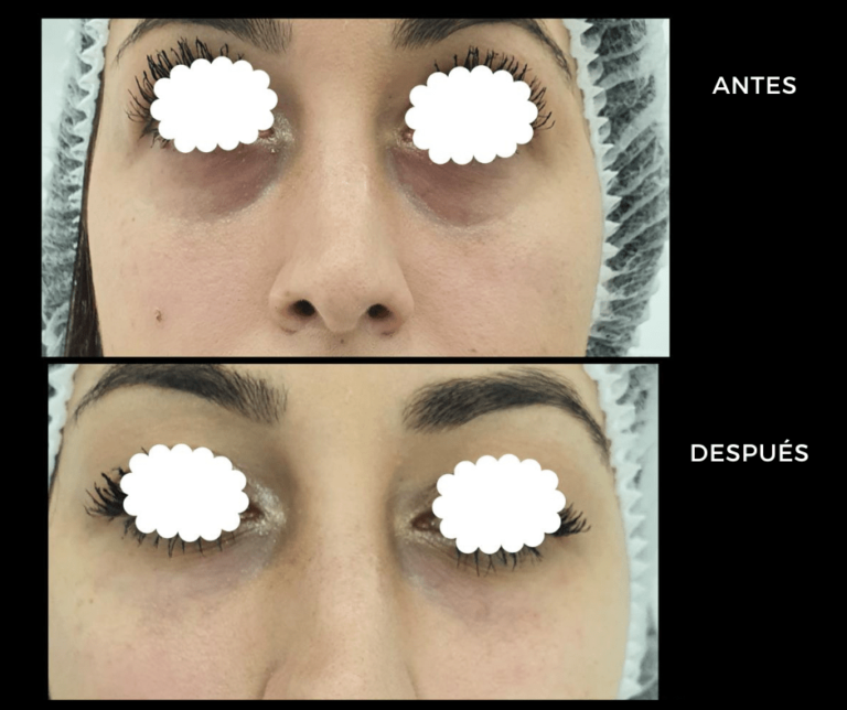 Corrección de ojeras con Ácido Hialurónico - Elegant Clinic Banús