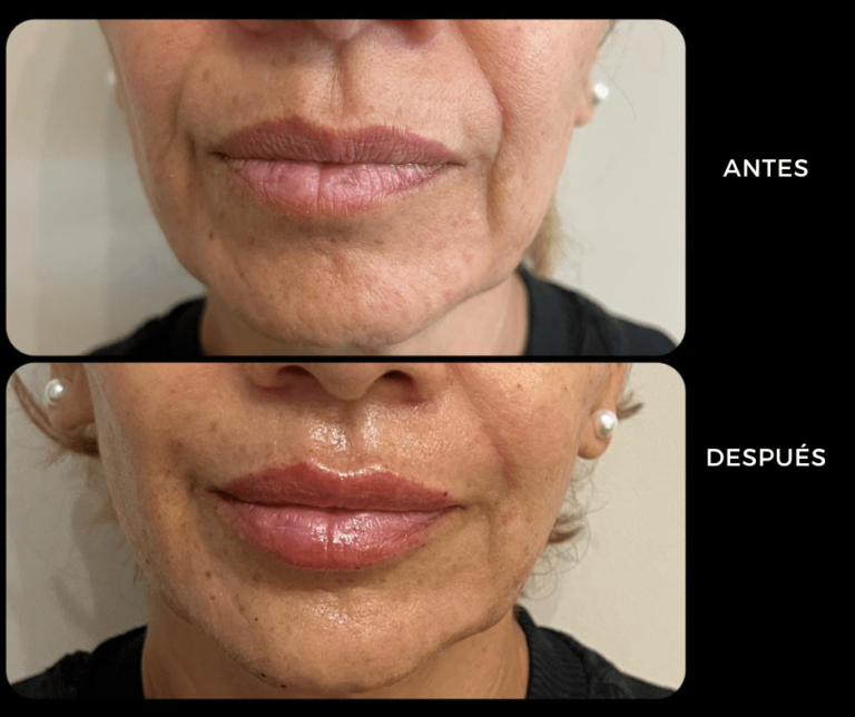 Relleno de labios con Ácido hialurónico - Elegant Clinic Banús