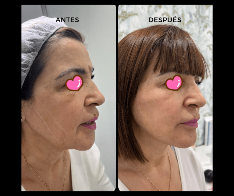 Hilos Tensores - Elegant Clinic Banús