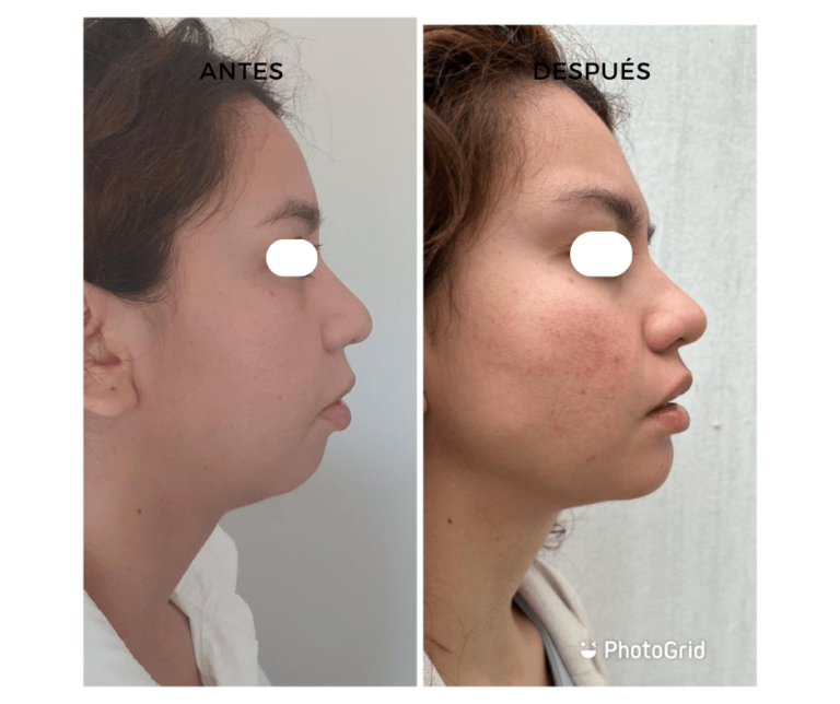 Marcación mandibular y proyección del mentón con Ácido Hialurónico - Elegant Clinic Banús