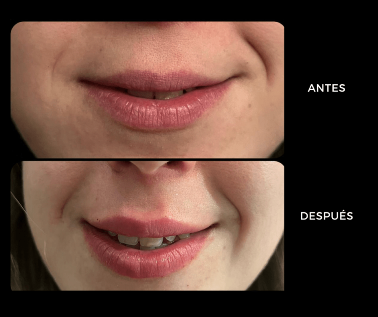 Relleno de labios con Ácido hialurónico en marbella - Elegant Clinic Banús