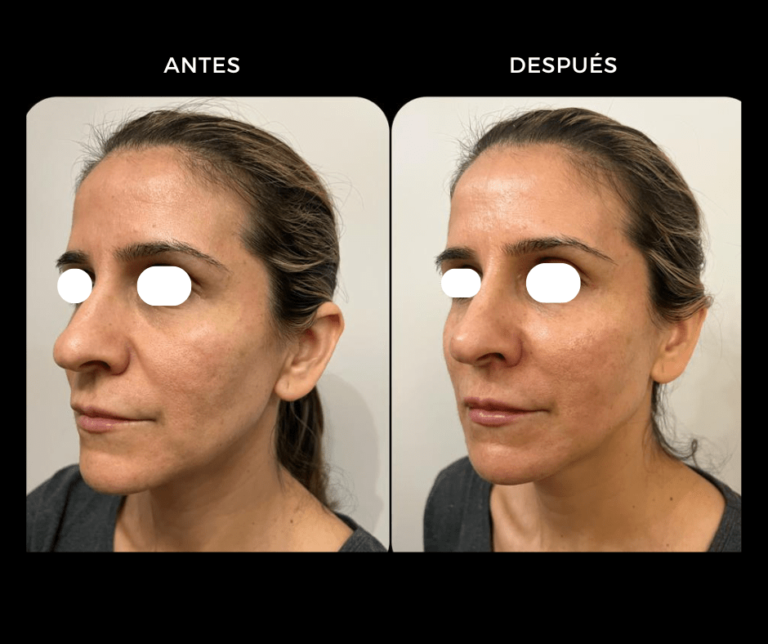 Estimuladores de colágeno Radiesse con técnica híbrido con Ácido hialurónico - Elegant Clinic Banús
