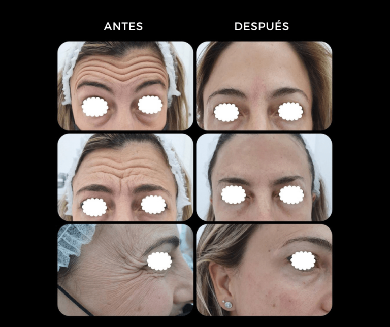 Neuromoduladores Tercio Superior - Elegant Clinic Banús