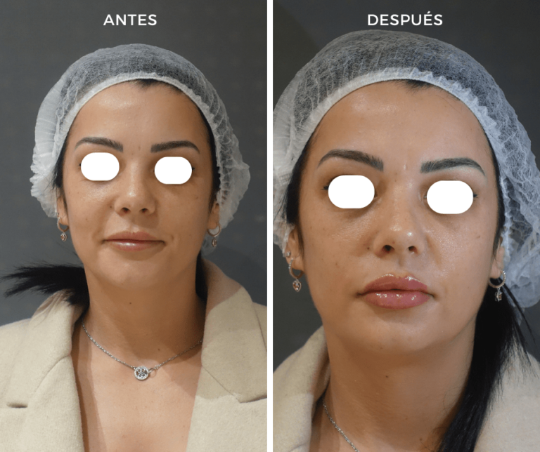 Foto B. Relleno de labios con Ácido hialurónico - Elegant Clinic Banús