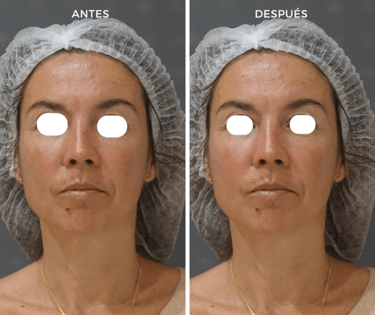 Tratamiento de Hydrafacial - Elegant Clinic Banús