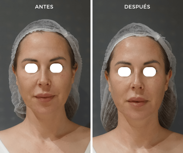 Tratamiento Dermapen antes y despues - Elegant Clinic Banús