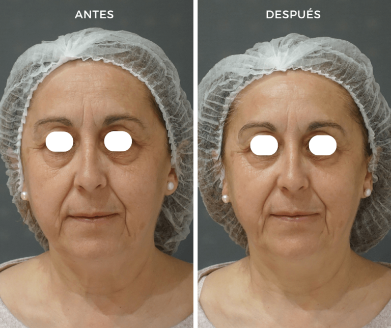 Hydrafacial antes y despues - Elegant Clinic Banús