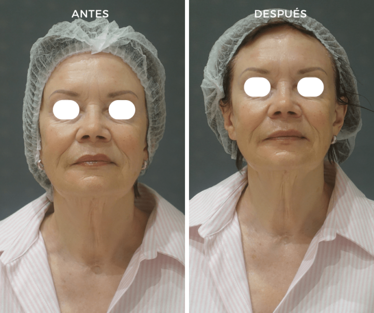 Tratamiento de Hydrafacial, antes y despues - Elegant Clinic Banús