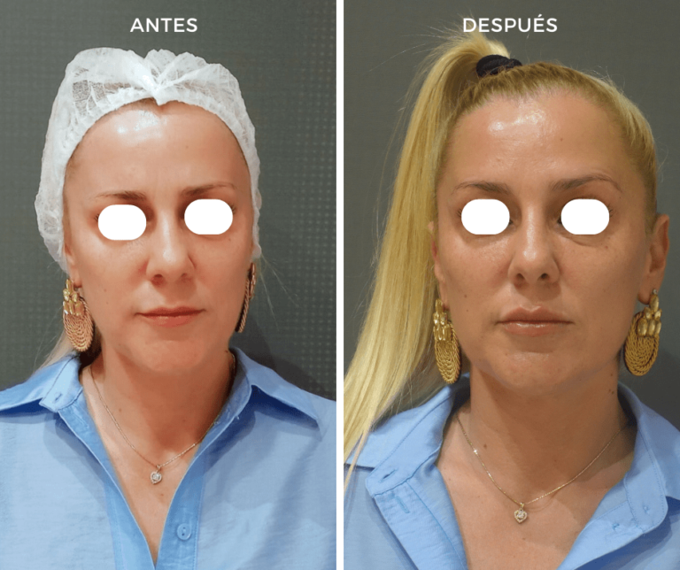Neuromoduladores Tercio Superior y relleno de labios con Ácido hialurónico - Elegant Clinic Banús