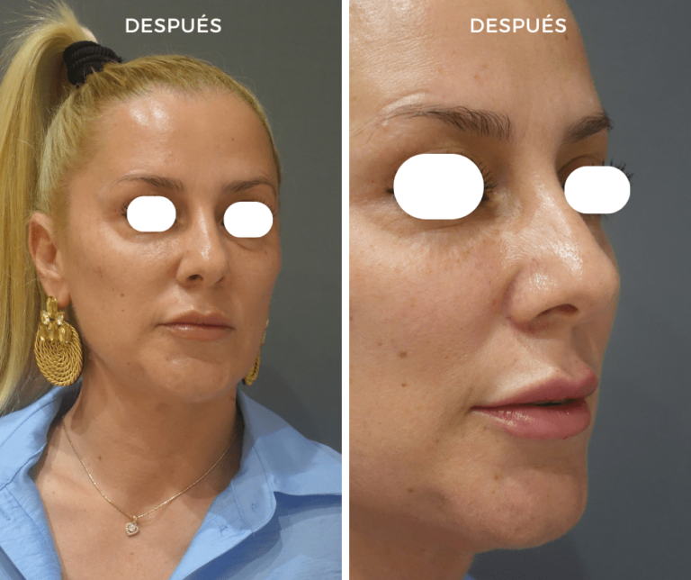 Neuromoduladores Tercio Superior y relleno de labios con Ácido hialurónico - Elegant Clinic Banús