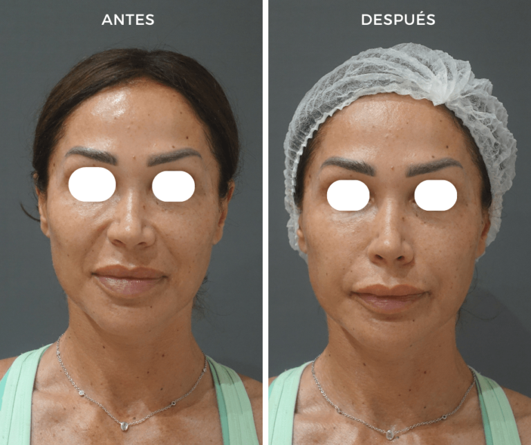 Tratamiento de Hydrafacial Platinum - Elegant Clinic Banús