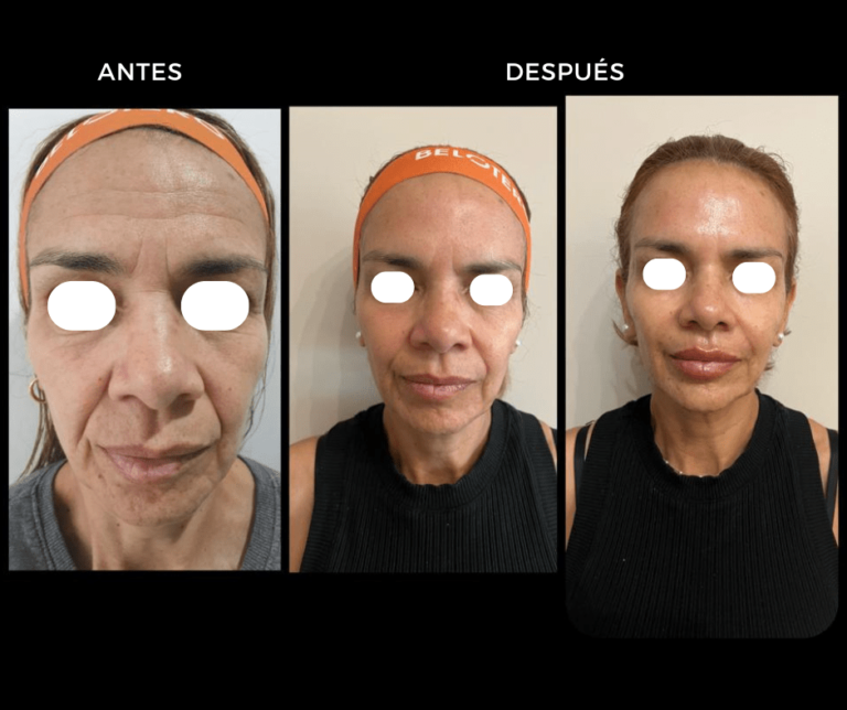 Ácido Hialurónico - Armonización Facial - Elegant Clinic Banús