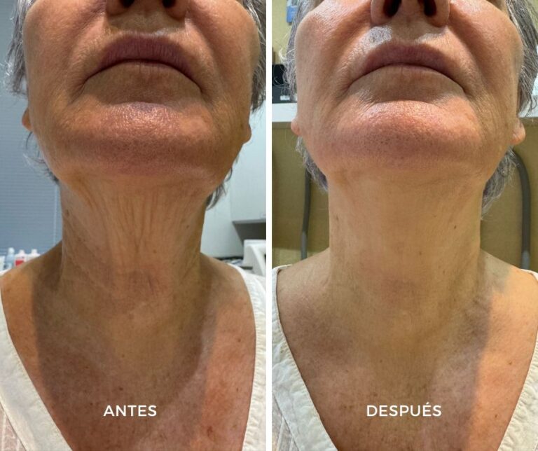 Estimuladores de colágeno Radiesse con técnica híbrido con Ácido hialurónico - Elegant Clinic Banús