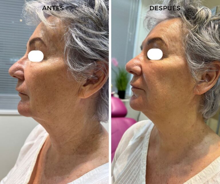 Estimuladores de colágeno Radiesse con técnica híbrido con Ácido hialurónico - Elegant Clinic Banús
