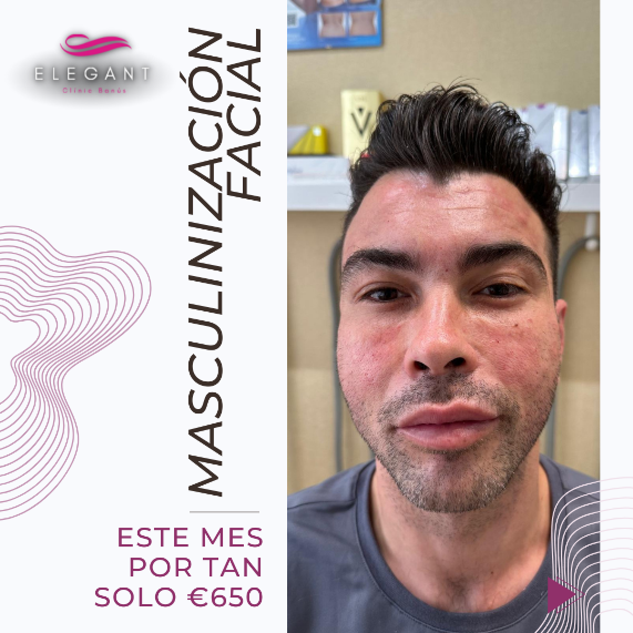 masculinización facial