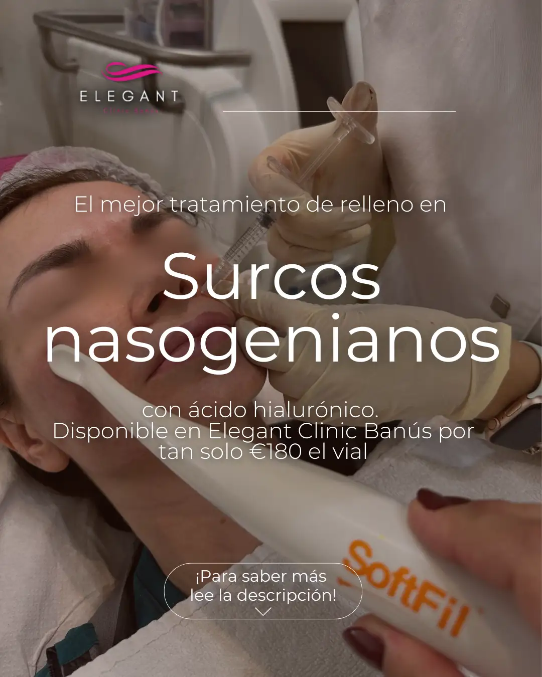 surcos nasogenianos - Elegant Clinic Banús
