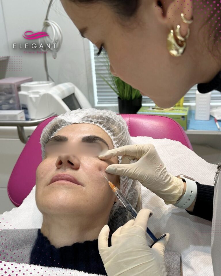 Tratamiento relleno de ojeras con ácido hialurónico en Elegant Clinic Banús