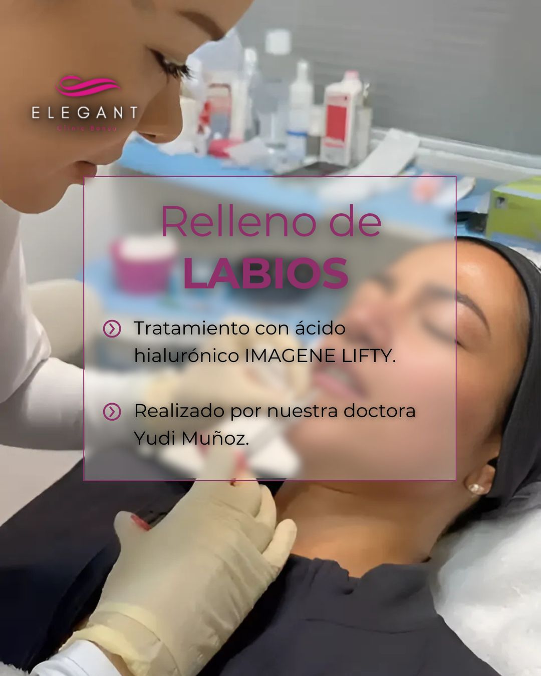 Relleno de labios con Ácido hialurónico en marbella - Elegant Clinic Banús