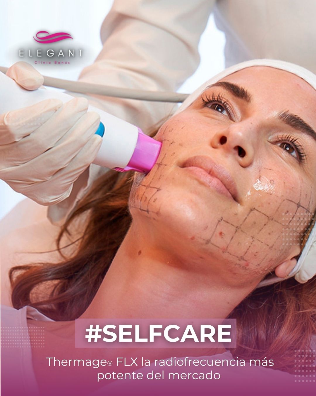 Thermage FLX®, la radiofrecuencia más potente del mundo en Elegant Clinic Banús