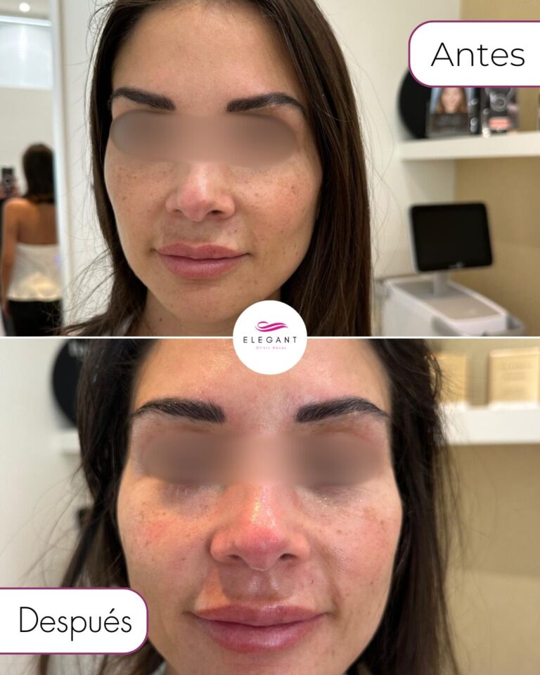 Hydrafacial en Marbella Elegant Clinic Banús