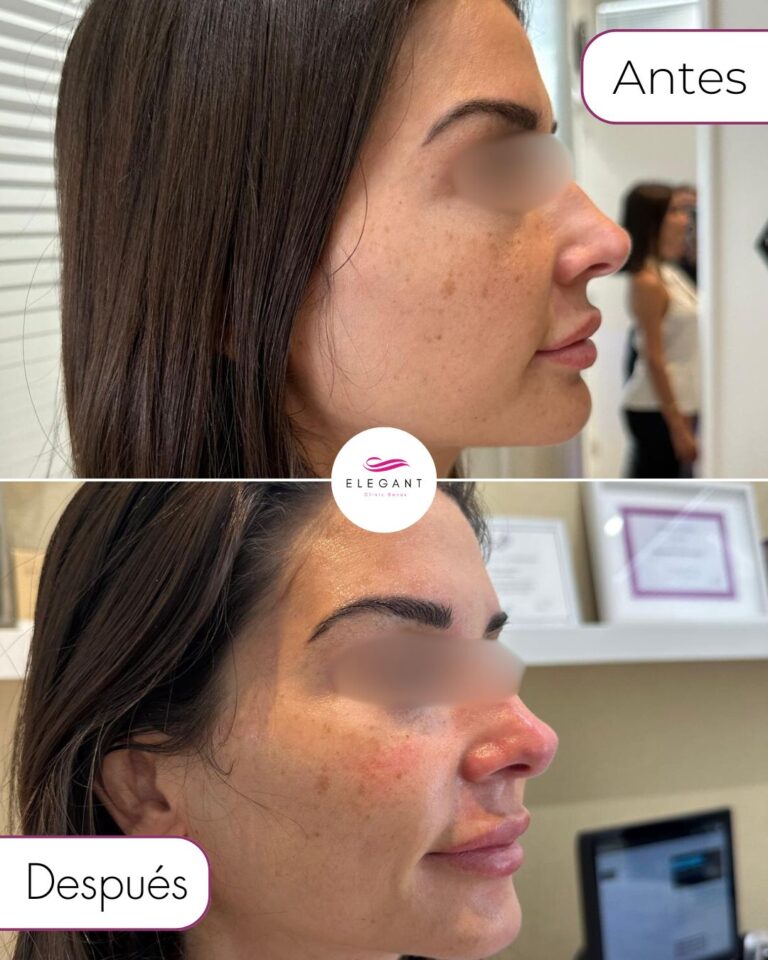 Hydrafacial en Marbella Elegant Clinic Banús