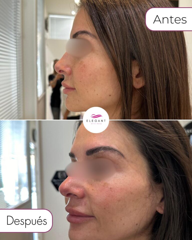 Hydrafacial en Marbella Elegant Clinic Banús